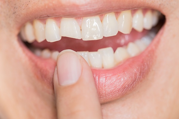 Why It Is Necessary To Repair A Chipped Tooth