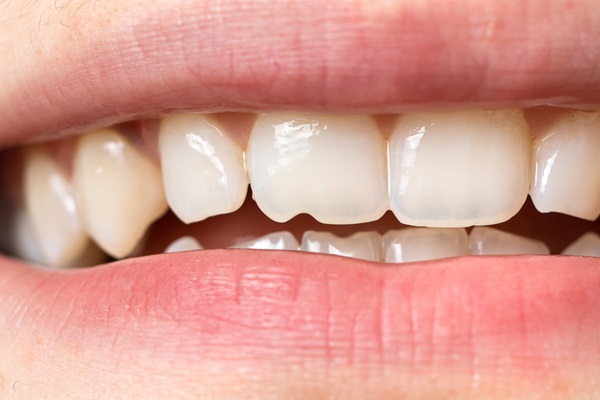 Tips For Preventing Chipped Teeth