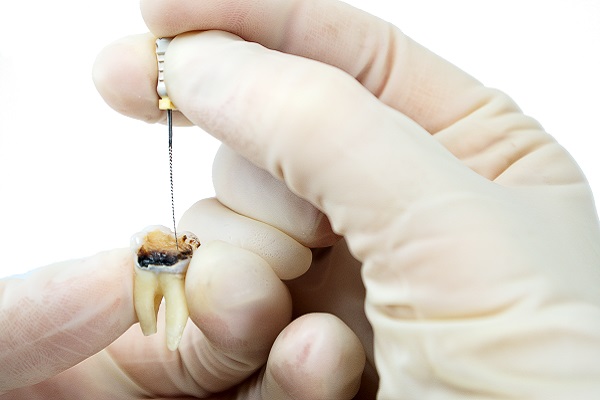 The Truth About Pain In Root Canal Procedures