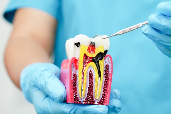 Tips To Prepare For Root Canal Therapy