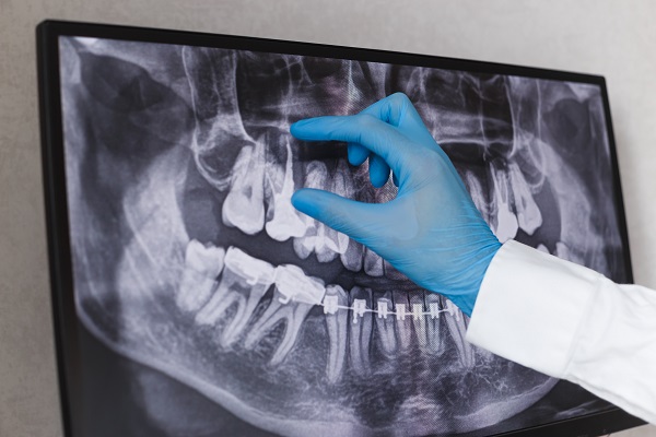 Root Canal Therapy Ukiah, CA
