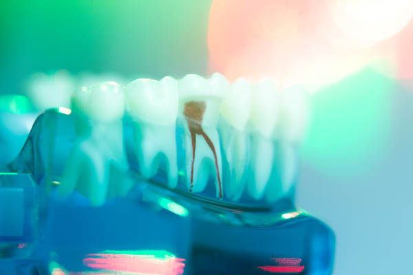 What Is The Purpose Of A Root Canal?